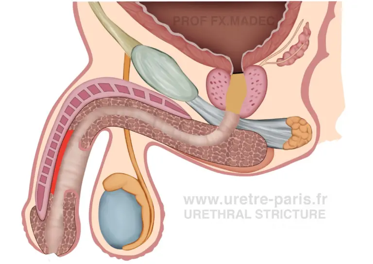رسم جراحي تفصيلي للمرحلة الأولى من رأب الإحليل على مرحلتين لعلاج تضيق الإحليل القضيب باستخدام طعم مخاطية الفم، يوضح وضع الطعم والتحضير لإعادة البناء في المرحلة التالية